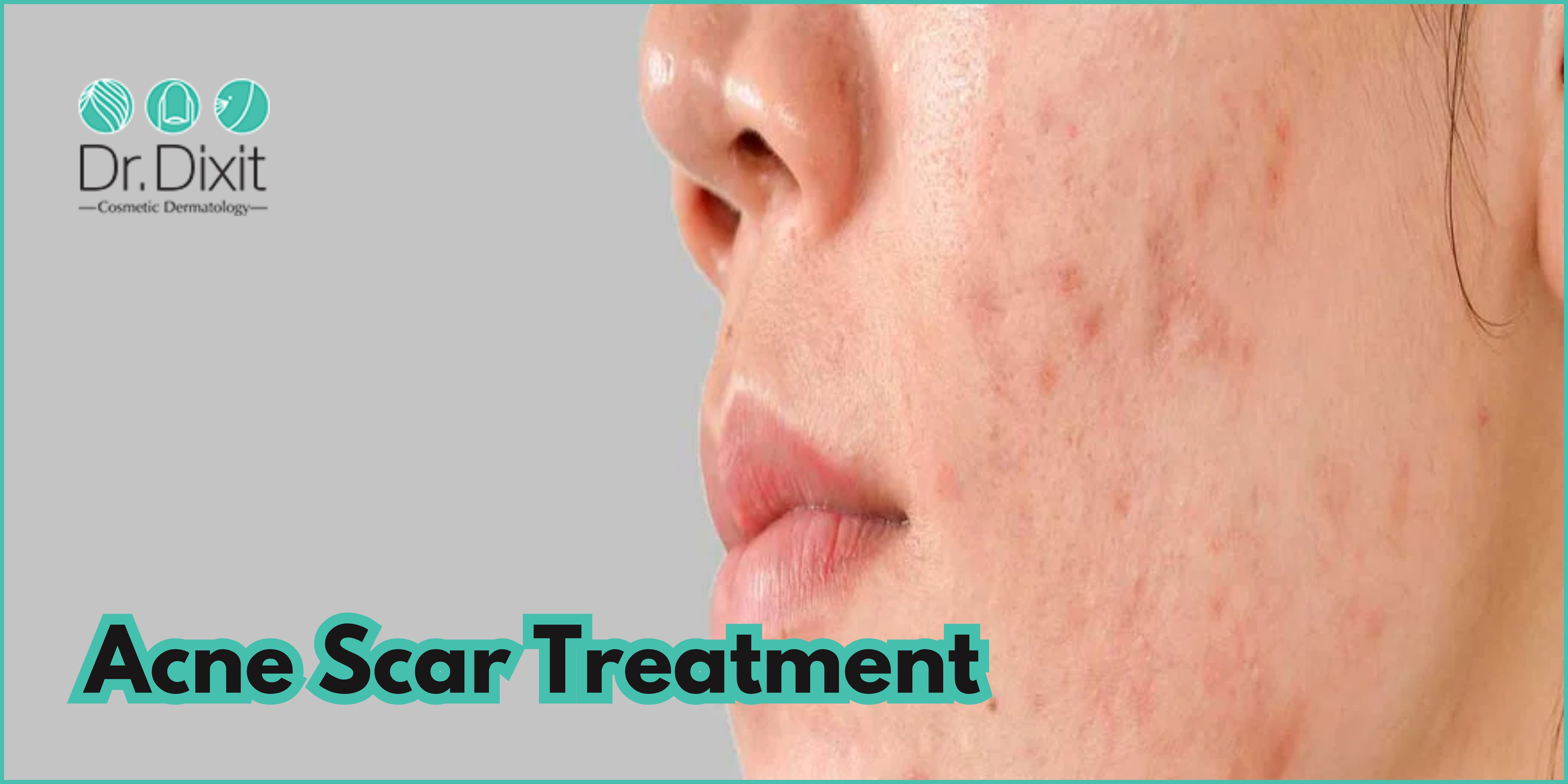 Acne Treatment In Bangalore | Lowest Cost Estimate